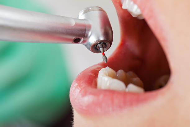 Best Emergency Tooth Extraction in Belmont Estates, VA